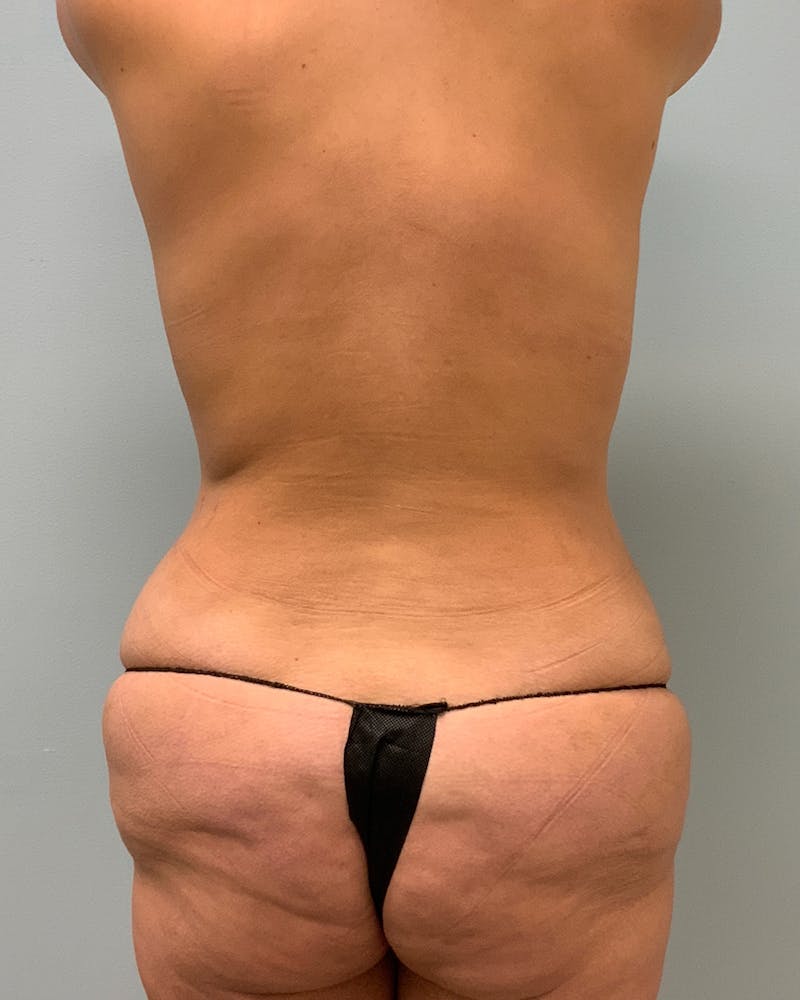 Body Lift Before & After Gallery - Patient 365805 - Image 3