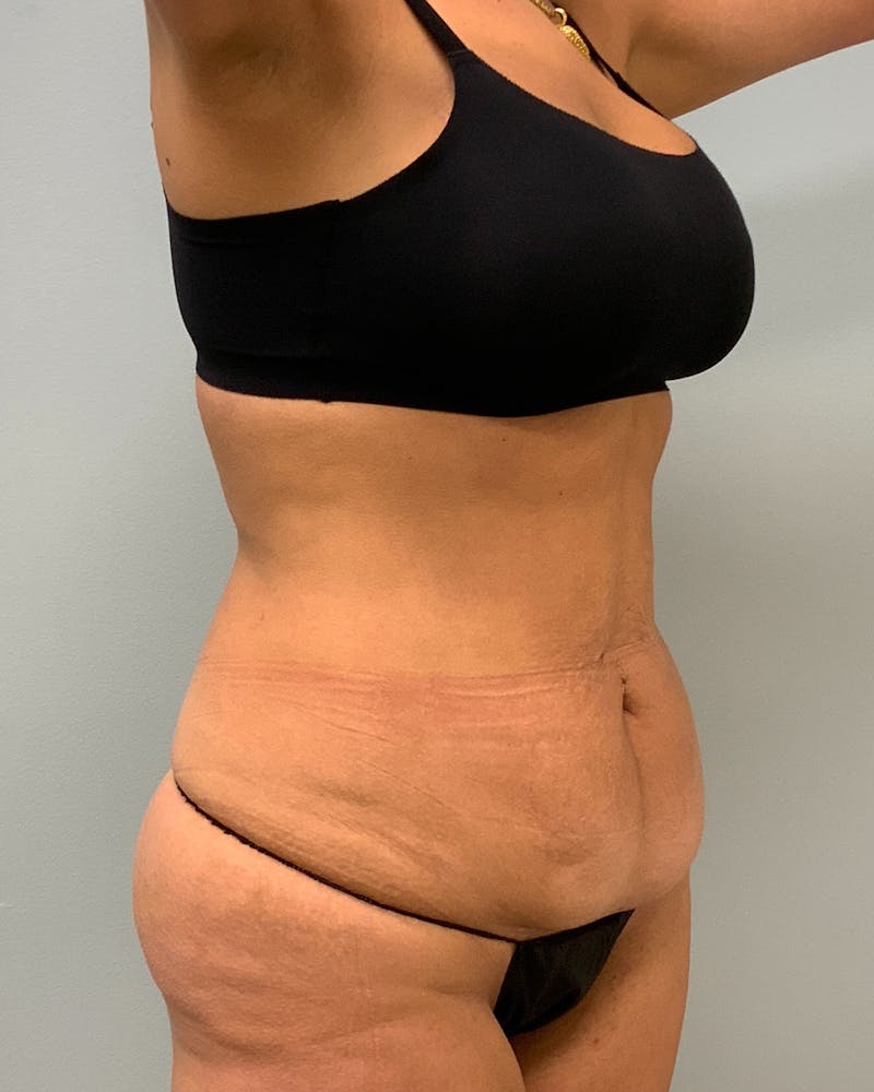 Patient QVisE11jTWyhIf3Srv5rxg - Body Lift Before & After Photos