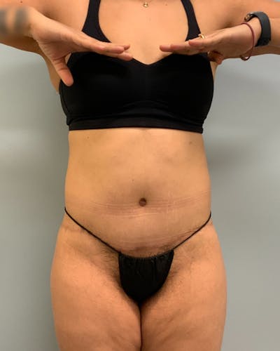 Body Lift Before & After Gallery - Patient 267712 - Image 2