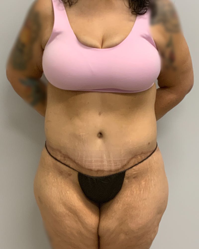 Body Lift Before & After Gallery - Patient 731767 - Image 2