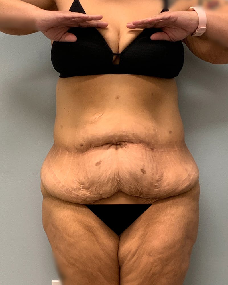 Body Lift Before & After Gallery - Patient 731767 - Image 1