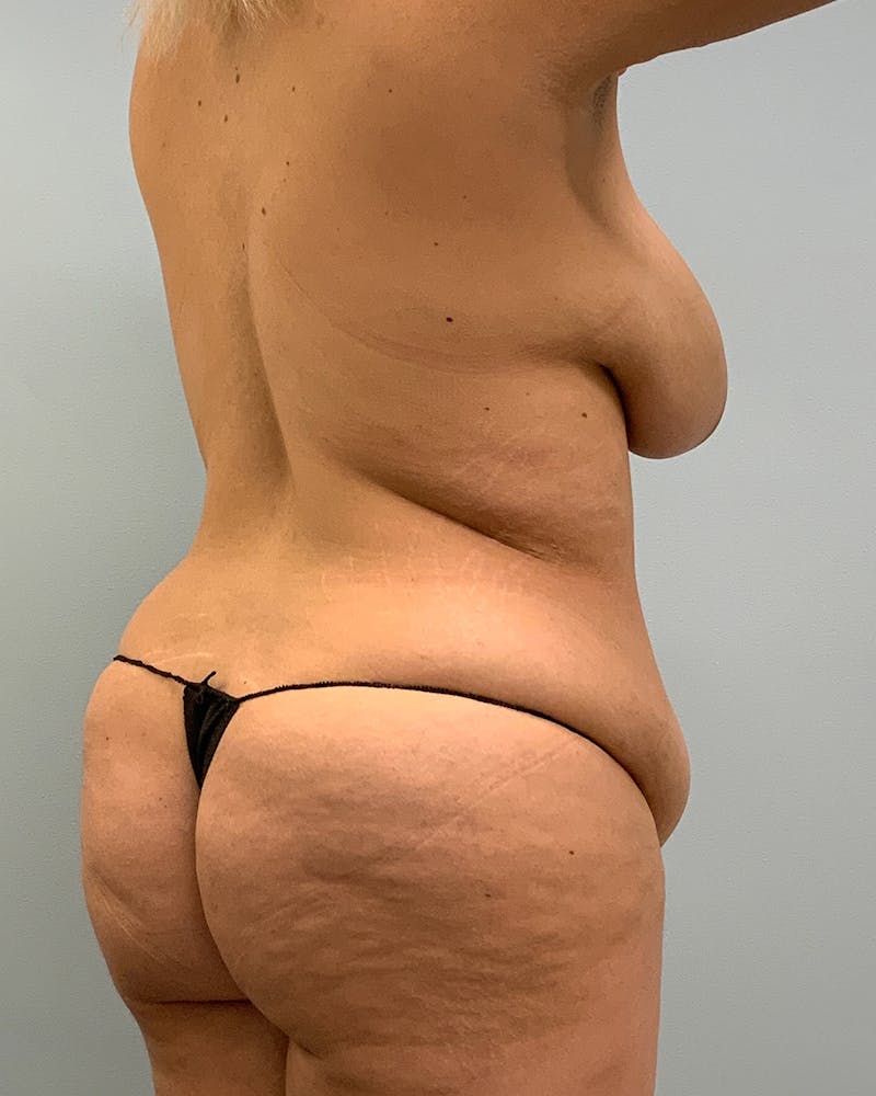 Body Lift Before & After Gallery - Patient 738625 - Image 3