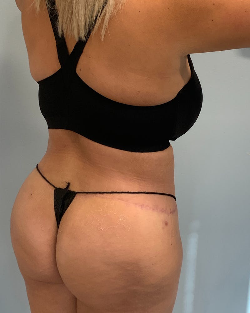 Body Lift Before & After Gallery - Patient 738625 - Image 4
