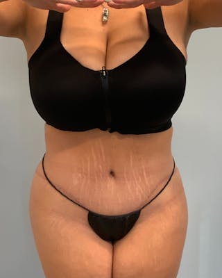 Body Lift Before & After Gallery - Patient 738625 - Image 2