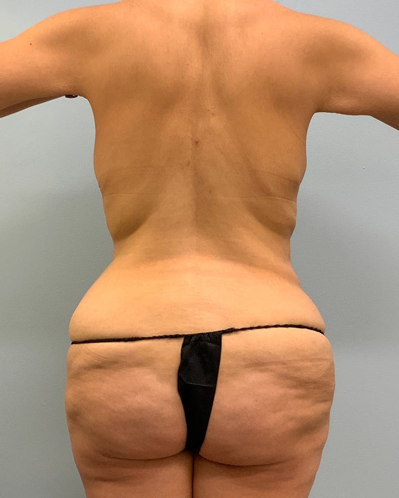 Patient OGAcbGrSRvem71zdiNT0rg - Body Lift Before & After Photos