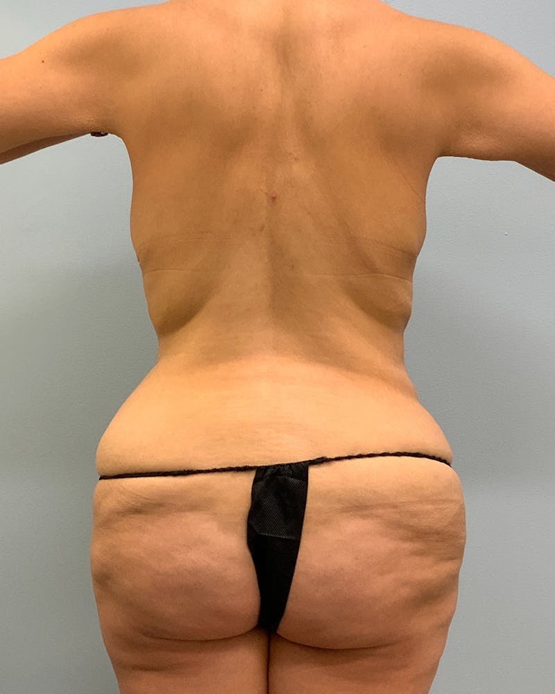 Body Lift Before & After Gallery - Patient 220604 - Image 1