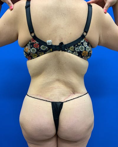 Body Lift Before & After Gallery - Patient 220604 - Image 2