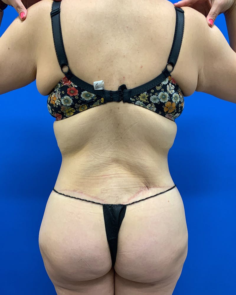 Body Lift Before & After Gallery - Patient 220604 - Image 2