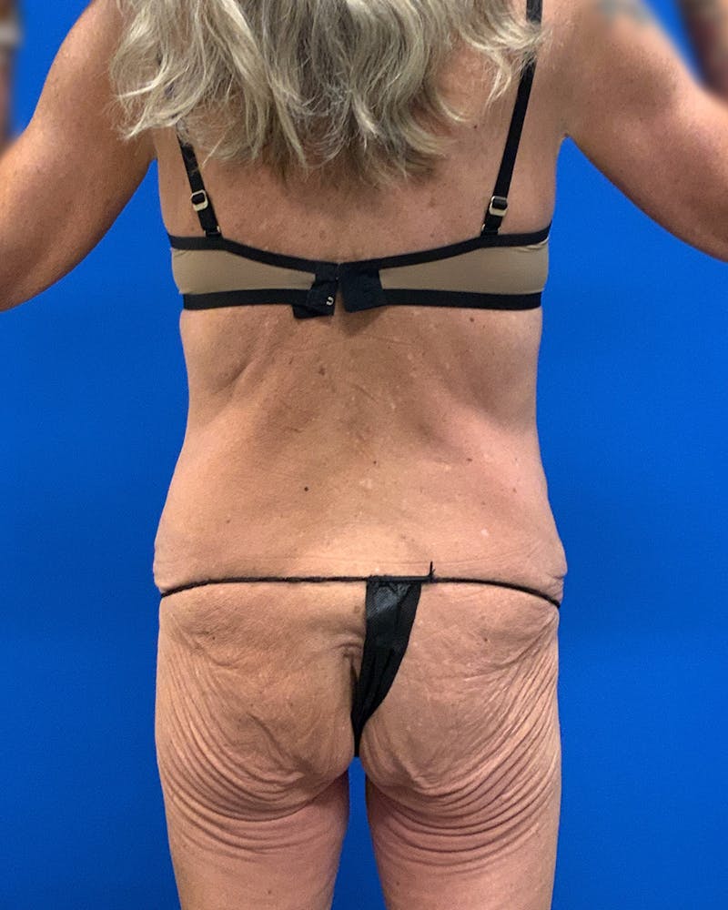 Body Lift Before & After Gallery - Patient 120008 - Image 5
