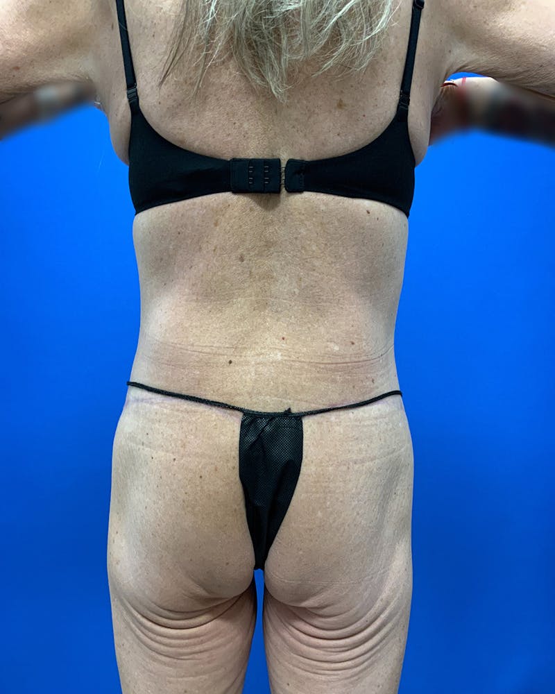 Body Lift Before & After Gallery - Patient 120008 - Image 6