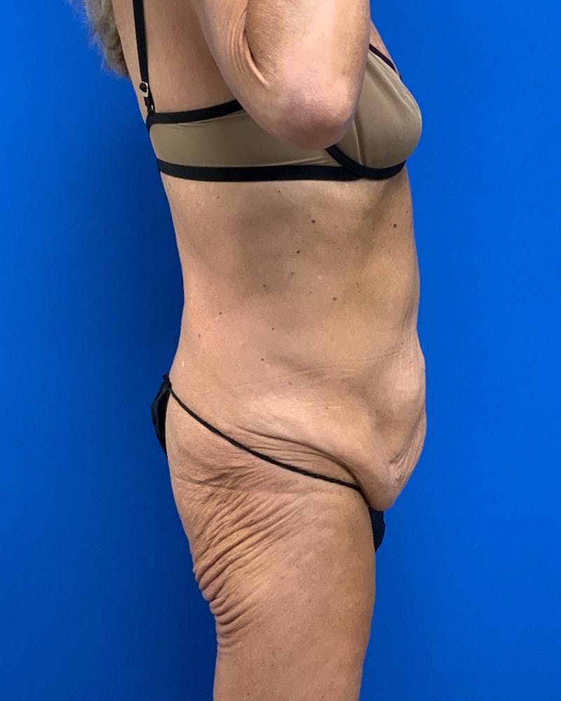 Body Lift Before & After Gallery - Patient 120008 - Image 3
