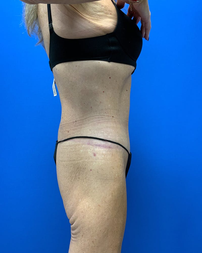 Body Lift Before & After Gallery - Patient 120008 - Image 4