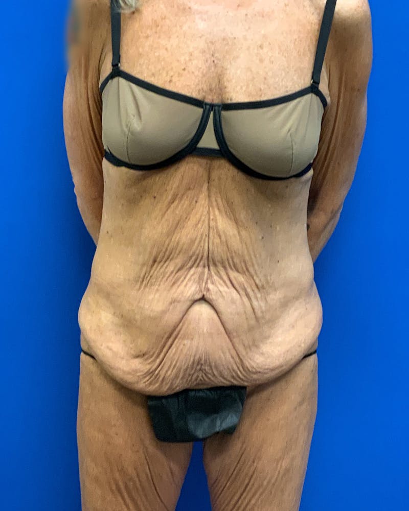 Body Lift Before & After Gallery - Patient 120008 - Image 1