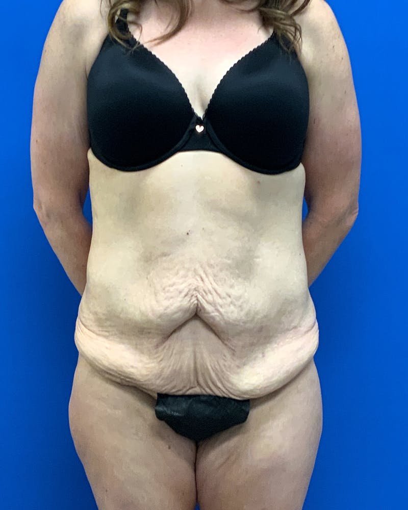 Body Lift Before & After Gallery - Patient 174980 - Image 1