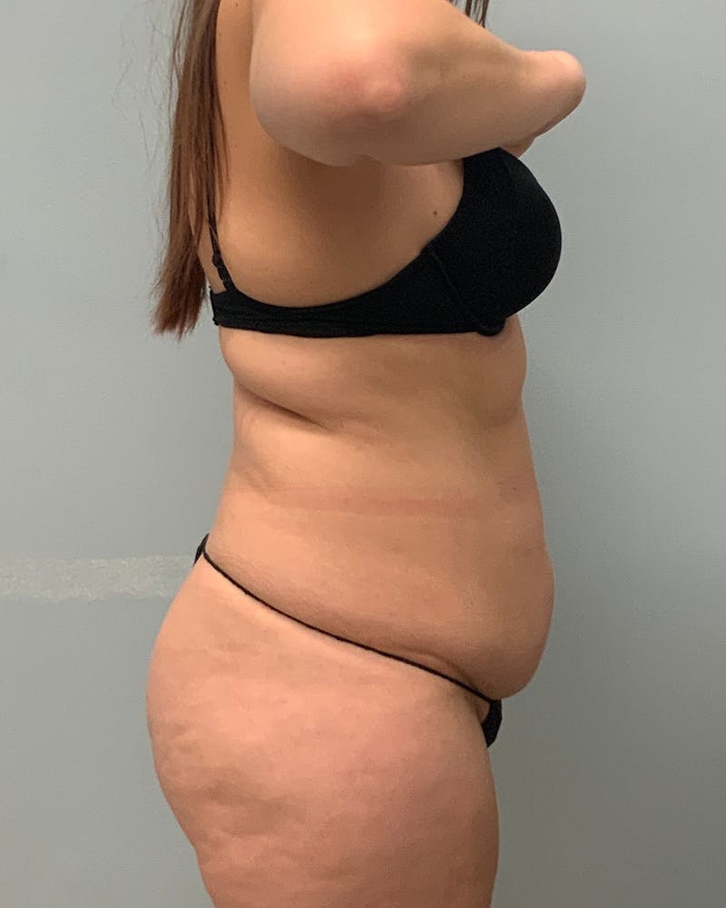 Patient eDsRtqJyQSKtoG_MVVBcLg - Body Lift Before & After Photos