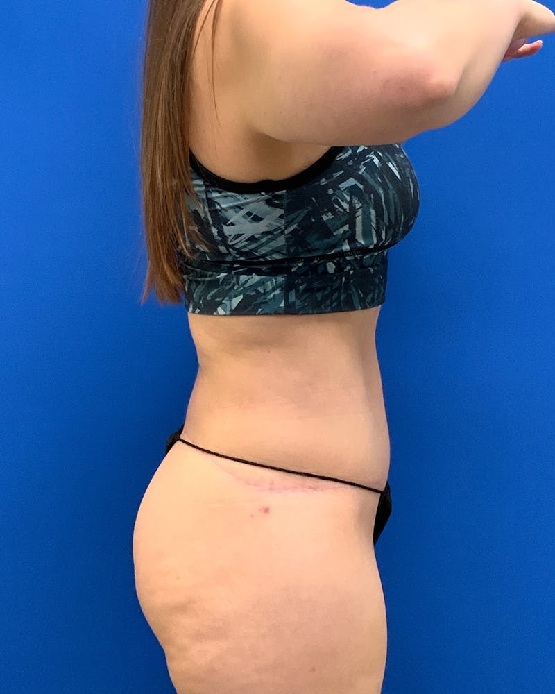 Body Lift Before & After Gallery - Patient 760543 - Image 2