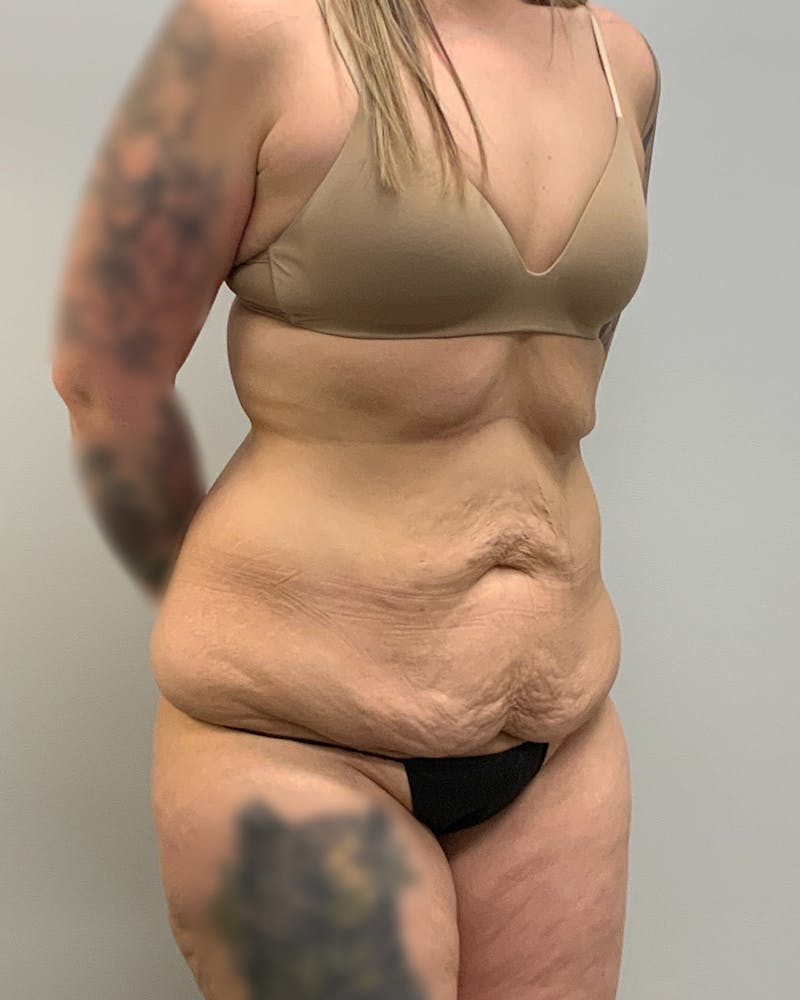 Body Lift Before & After Gallery - Patient 318476 - Image 1
