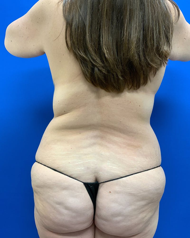 Body Lift Before & After Gallery - Patient 249532 - Image 3