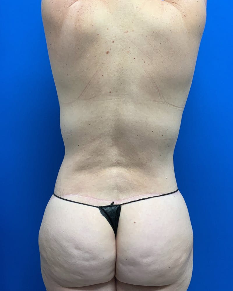 Body Lift Before & After Gallery - Patient 249532 - Image 4