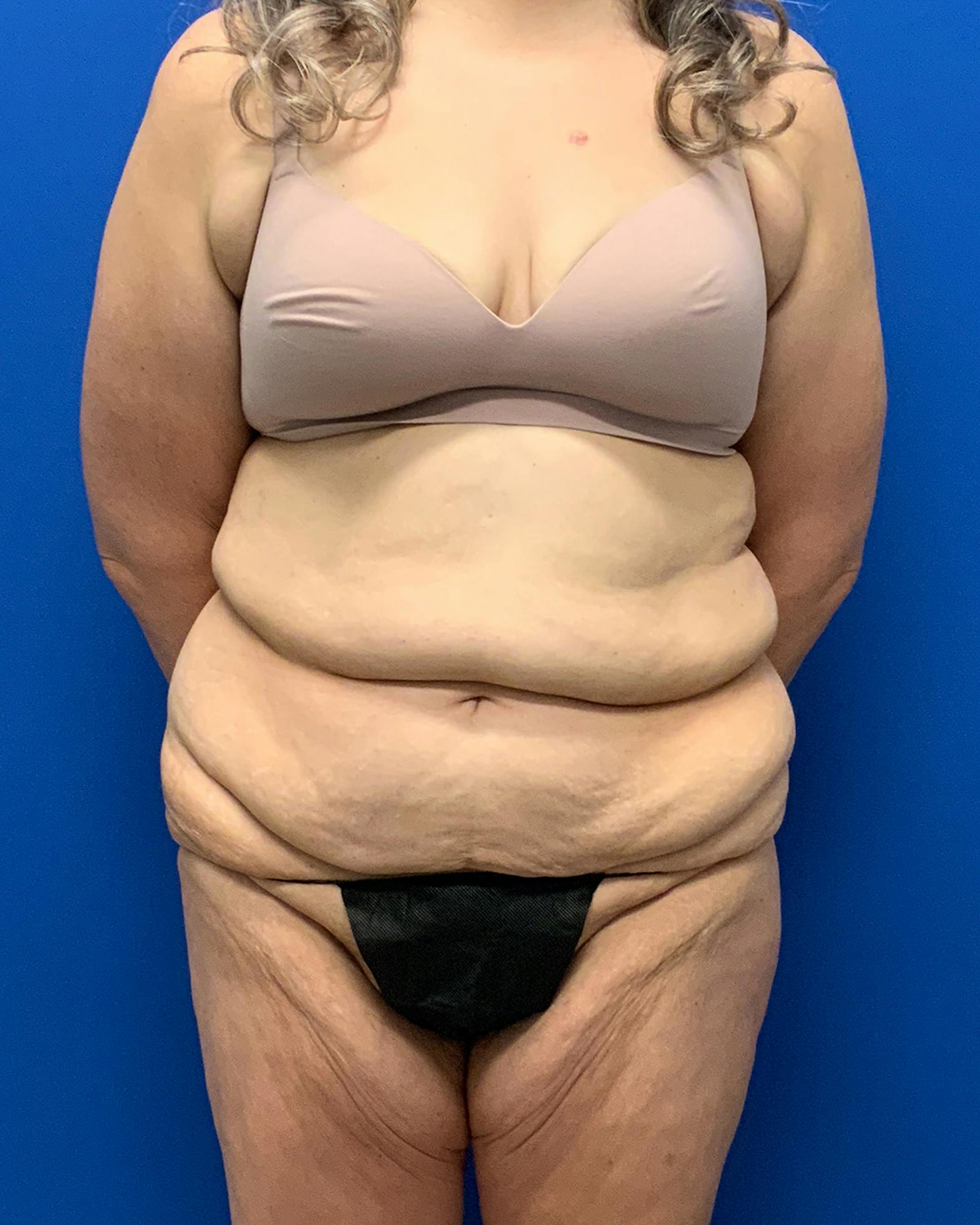 Body lift patient before media