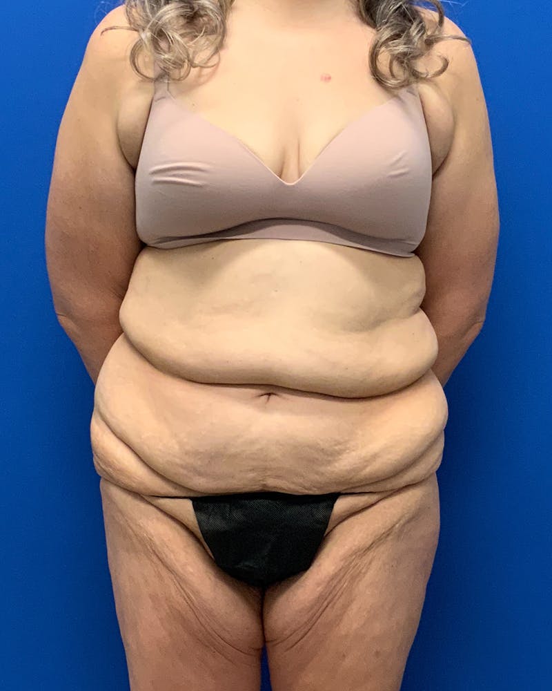 Body Lift Before & After Gallery - Patient 150549 - Image 1