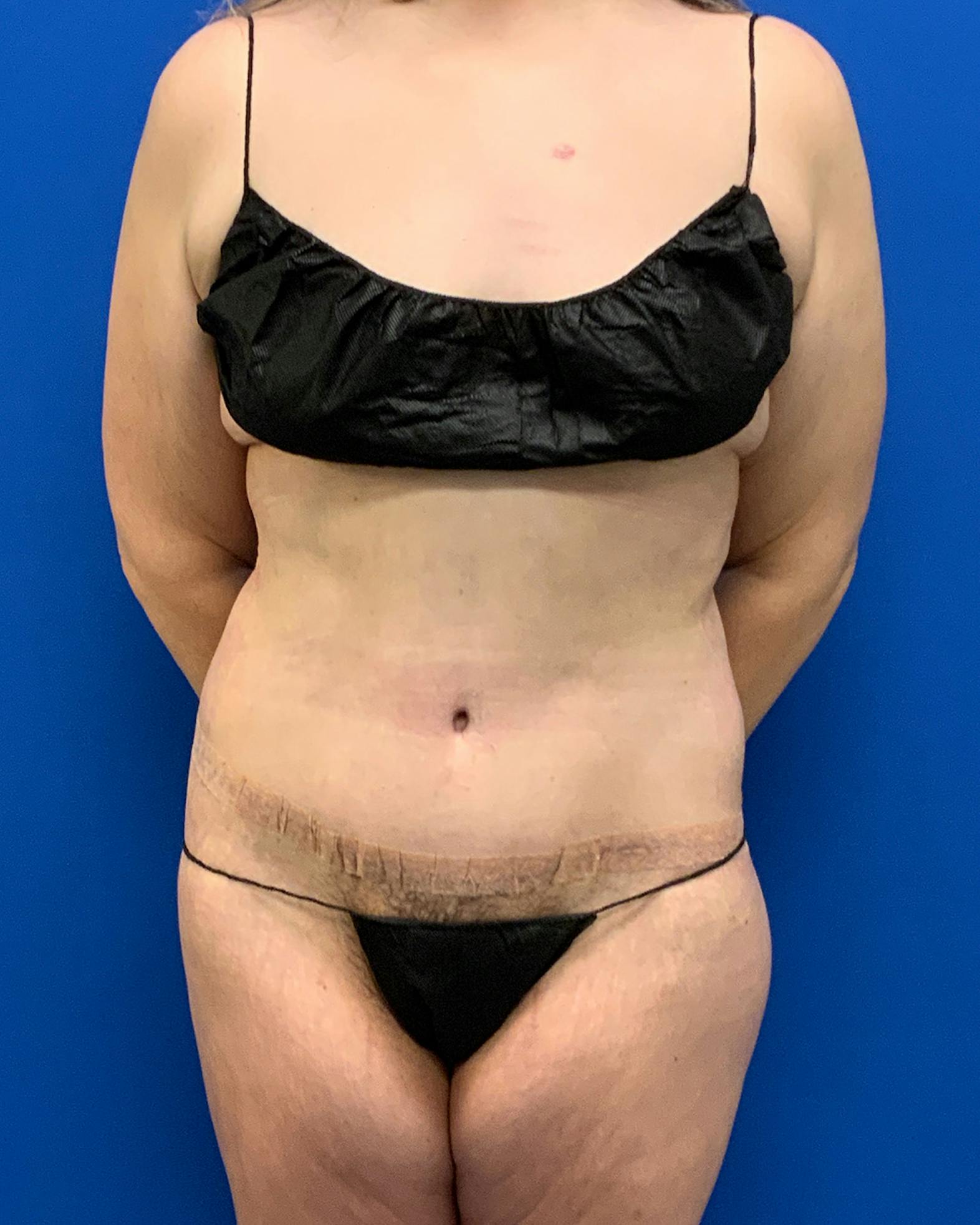 Body lift patient after media