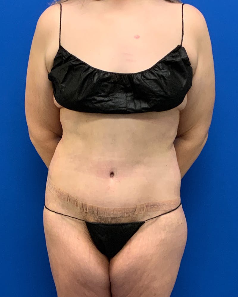 Body Lift Before & After Gallery - Patient 150549 - Image 2
