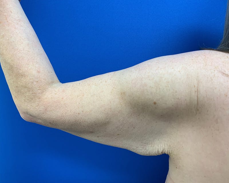 Patient Q7eKvM2ZS7yciB1YnzHEVA - Brachioplasty Before & After Photos