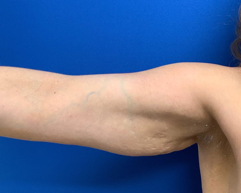 Patient HoDFkqQISyuUmcB86L4k4Q - Arm Lift Before & After Photos