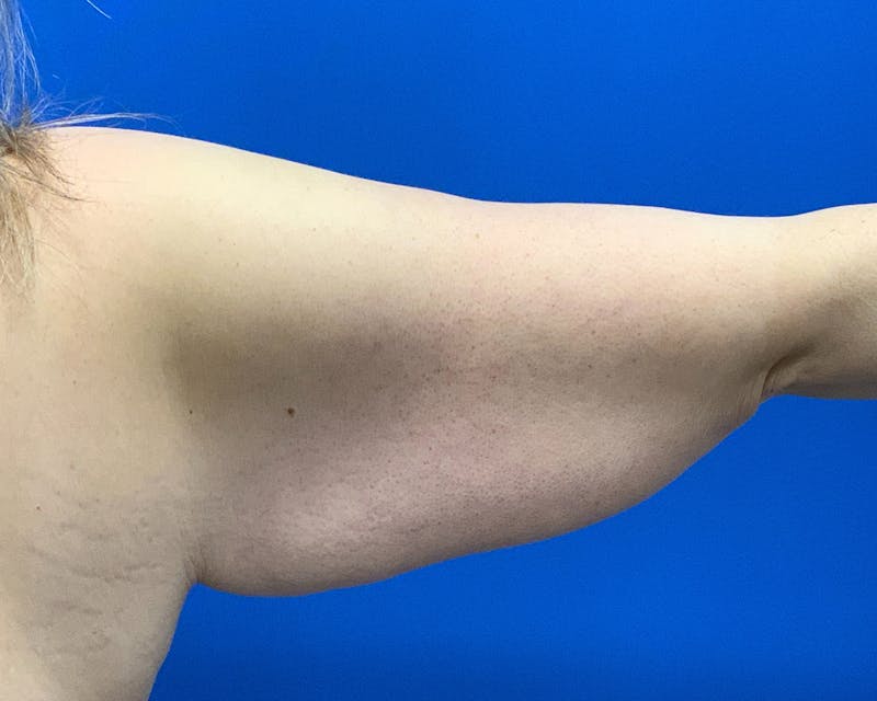 Patient WGdKvWzRSymt0l4JIsJHXw - Arm Lift Before & After Photos