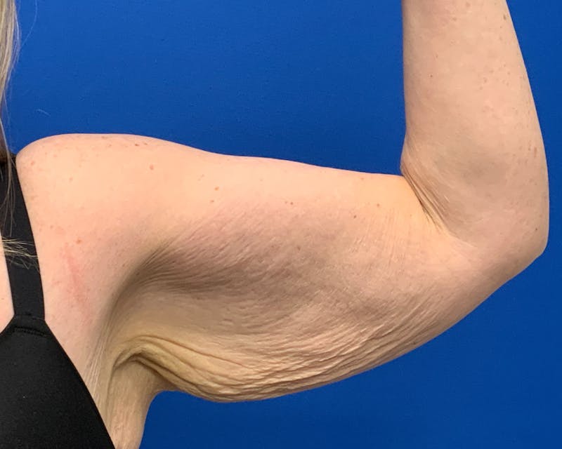 Patient PDTedep2QUiw6j67froswg - Arm Lift Before & After Photos