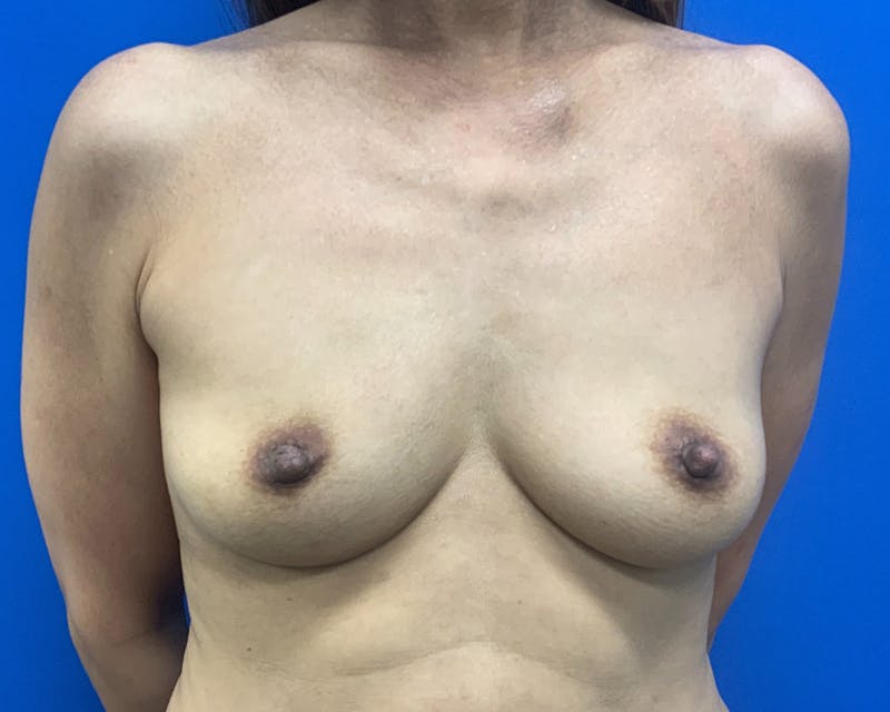 Patient Wq3FAQUfRPeErI6yrYcdmQ - Breast Augmentation Before & After Photos
