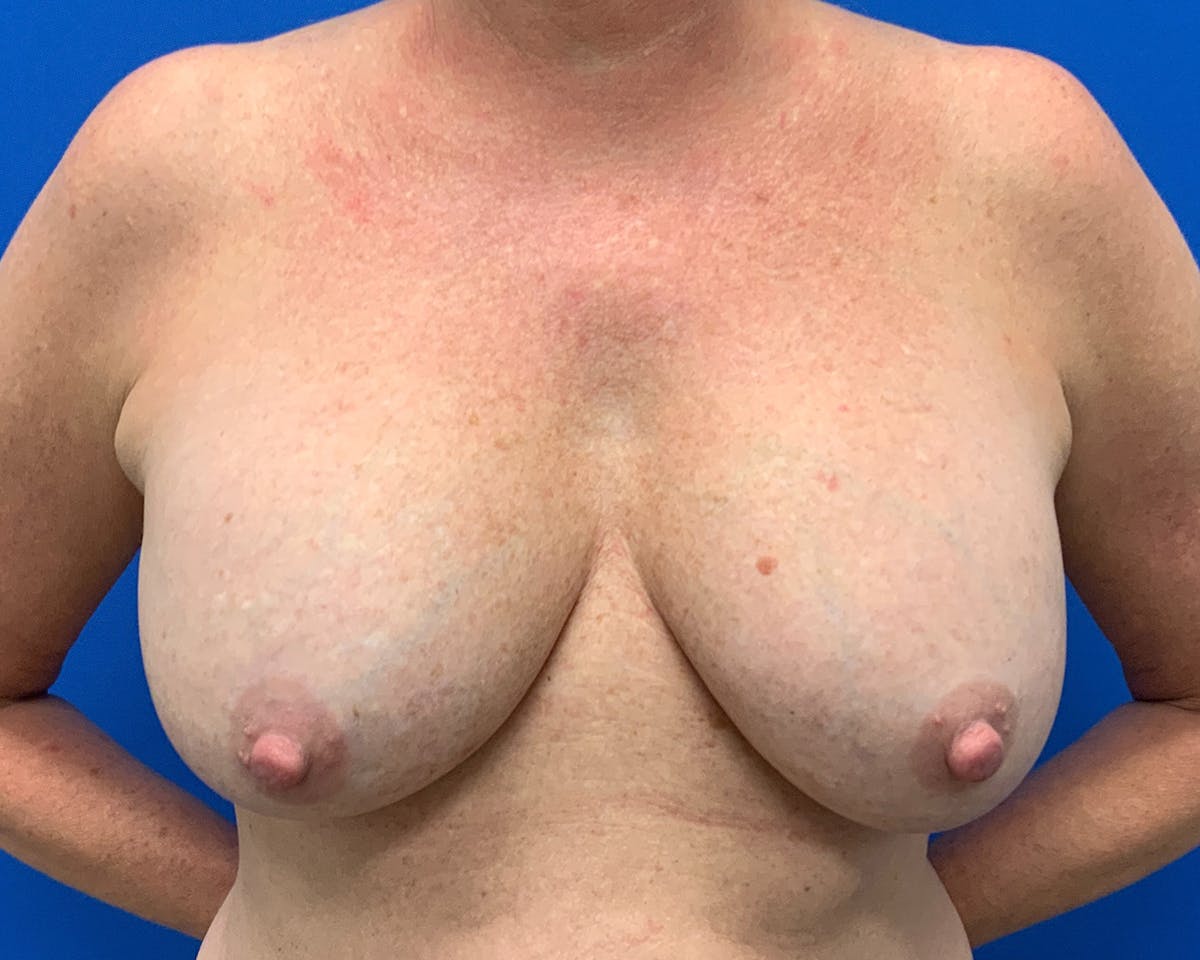 Breast Augmentation & Lift Before & After Gallery - Patient 958396 - Image 1
