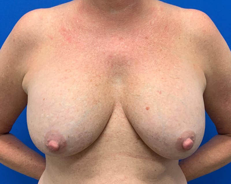 Patient Hs4rnRA7QMKP2cqfUERUNg - Breast Augmentation & Lift Before & After Photos