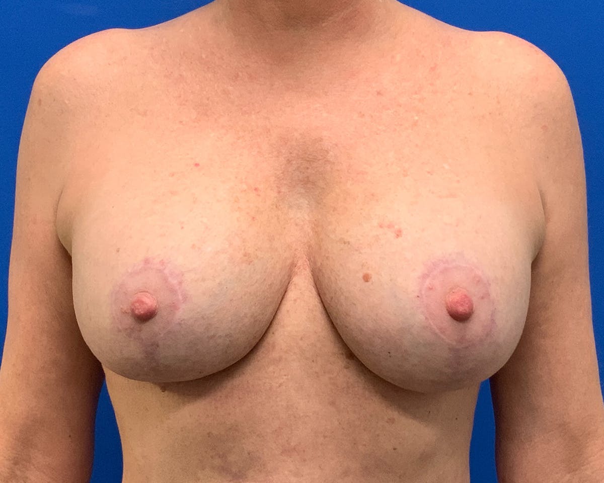 Breast Augmentation & Lift Before & After Gallery - Patient 958396 - Image 2