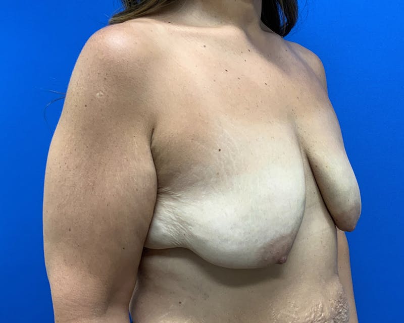 Patient YKukfSIRQPCwQruhl4SqTw - Breast Augmentation & Lift Before & After Photos