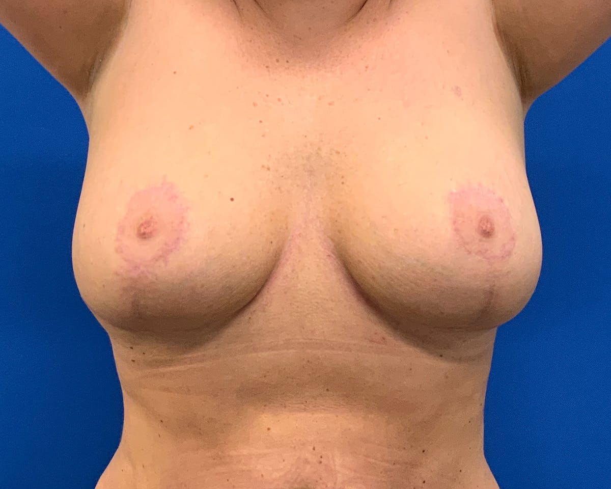 Breast Augmentation & Lift Before & After Gallery - Patient 946899 - Image 2