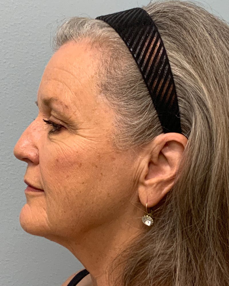 Facelift Before & After Gallery - Patient 240245 - Image 1