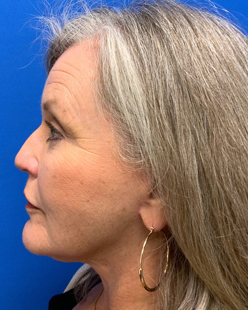 Neck Lift Before & After Gallery - Patient 130226 - Image 2