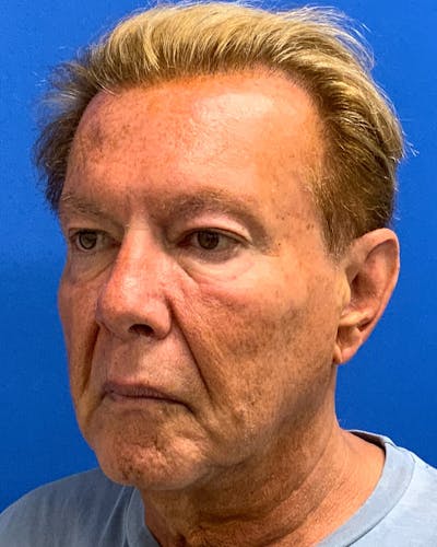 Neck Lift Before & After Gallery - Patient 368953 - Image 1