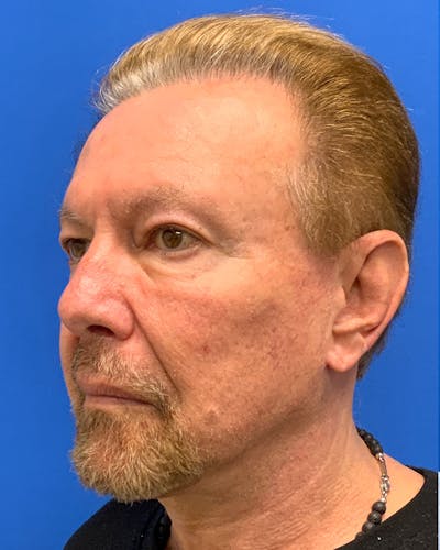 Neck Lift Before & After Gallery - Patient 368953 - Image 2