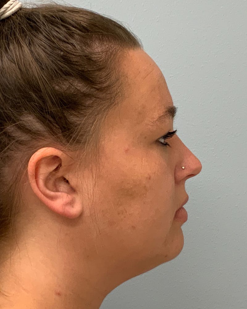 Chin & Neck Liposuction Before & After Gallery - Patient 266399 - Image 1