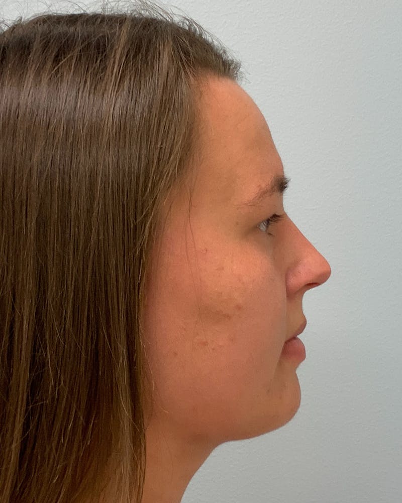 Chin & Neck Liposuction Before & After Gallery - Patient 266399 - Image 2