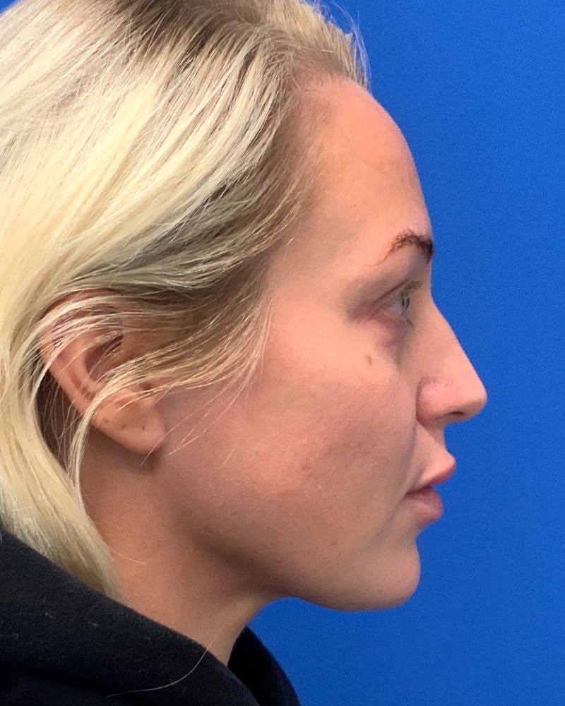 Chin & Neck Liposuction Before & After Gallery - Patient 577431 - Image 2