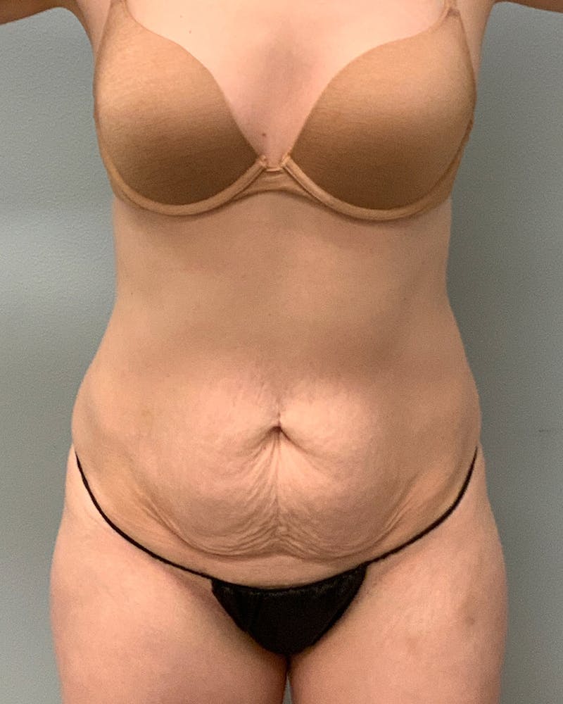 Patient B9DkGlqaRluOJu6Pl-js2Q - Tummy Tuck Before & After Photos