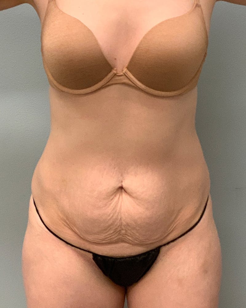 Abdominoplasty Before & After Gallery - Patient 392910 - Image 1