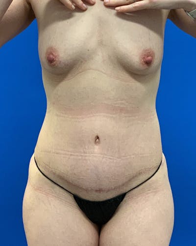 Abdominoplasty Before & After Gallery - Patient 392910 - Image 2