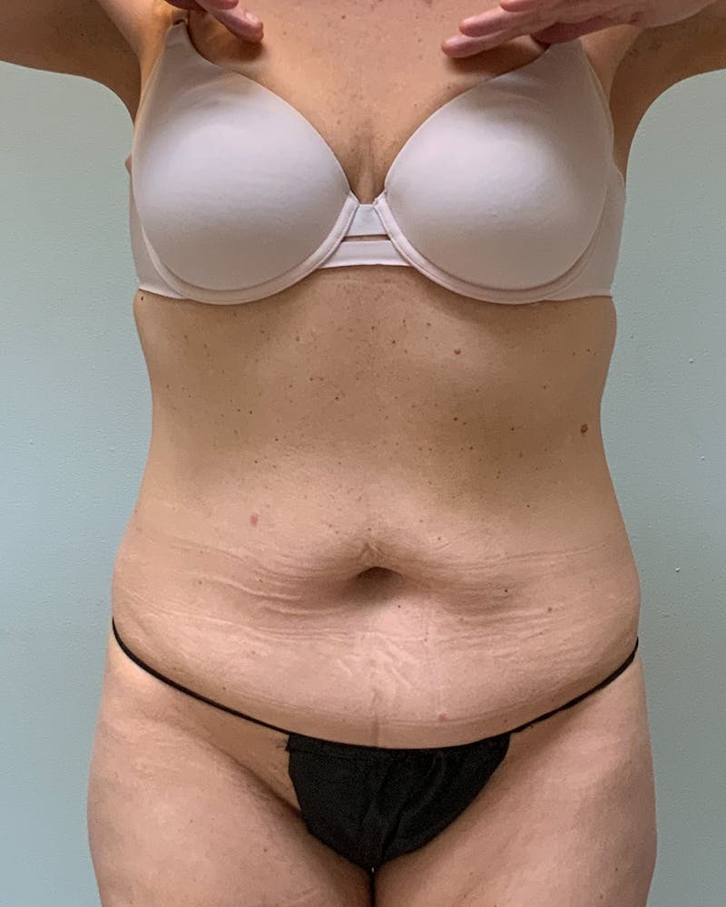 Patient RNmB81xDRHGiCjrLi_M77A - Tummy Tuck Before & After Photos