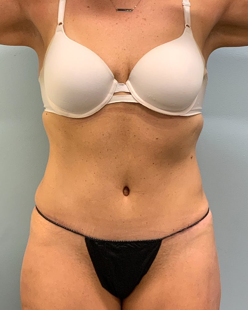 Abdominoplasty Before & After Gallery - Patient 227727 - Image 2