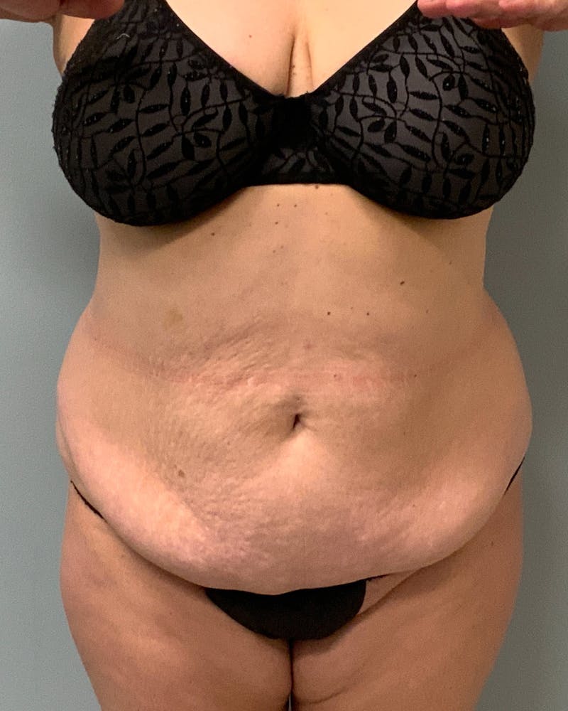 Patient QMyX1v6DRHmfah4wFCUlFA - Tummy Tuck Before & After Photos